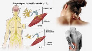 โรคเอแอลเอส หรือโรค Amyotrophic lateral sclerosis (ALS/MND)